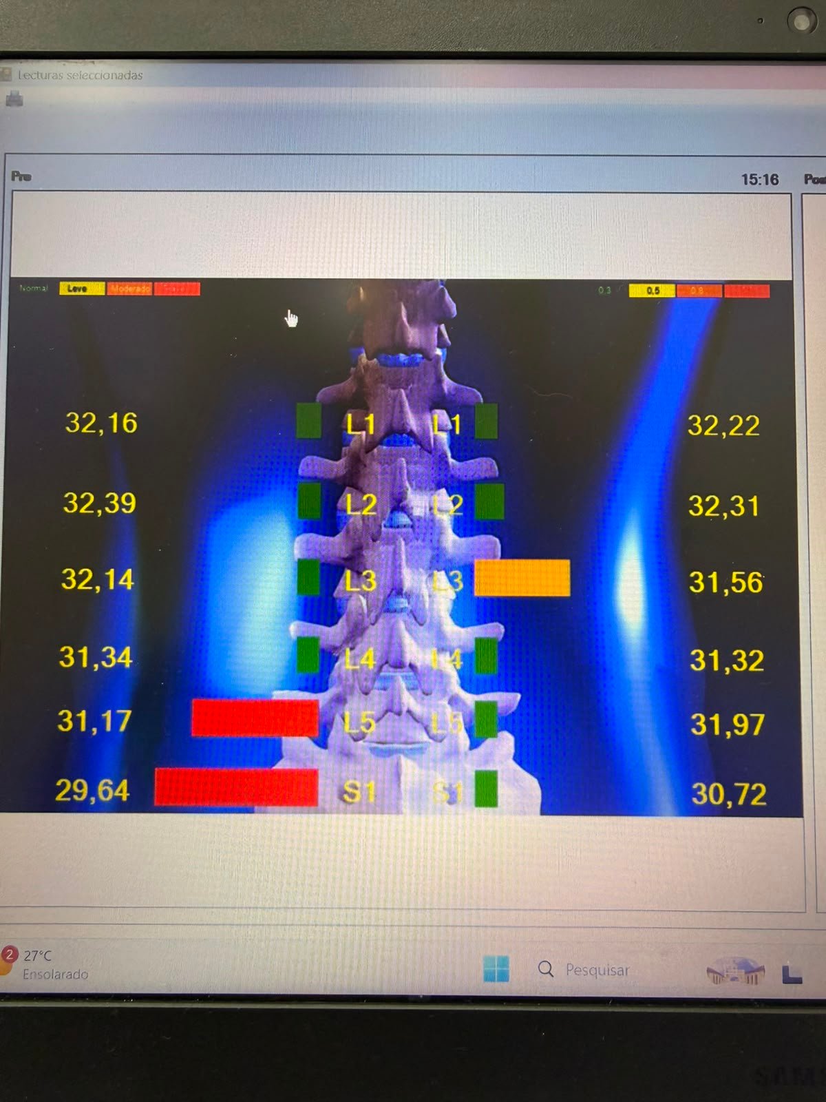 Termografia da Coluna Vertebral
